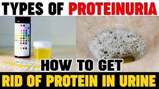 Types Of Proteinuria  How To Get Rid Of Protein In Urine  Kidney Expert  Karma Ayurveda Reviews [upl. by Luann]