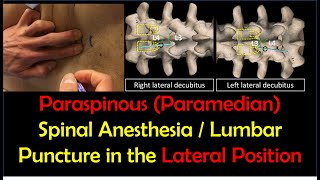 LUMBAR PUNCTURE  SPINAL TAP LUMBER PUNCTURE PROCEDURE  CSF STUDY EPIDURALshorts Dr Raj [upl. by Savadove889]