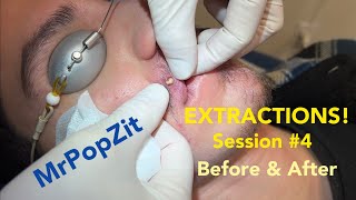 Severe Acne extractions Session 4 amazing before and after So many pops [upl. by Bigner509]