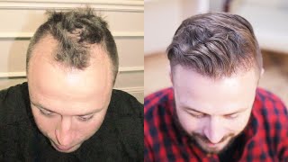 Hair Transplant Testimonial  Alan [upl. by Newob899]