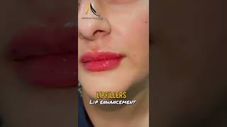 Lip Fillers  Lip Enhancement Treatment [upl. by Aerdnwahs]