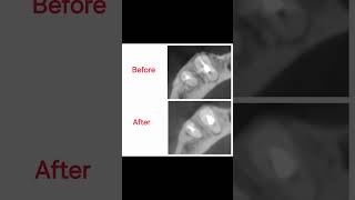 Healing of a periapical lesion encircling a mandibular canine [upl. by Tai]