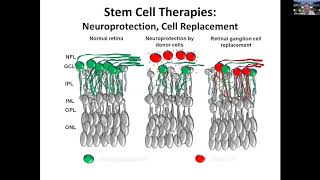 Regeneration and stem cell transplantation as treatment for optic neuropathies [upl. by Oecile]