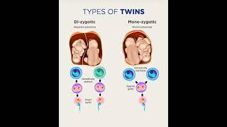 Types of twins Dizygotic Monozygotic [upl. by Caravette]