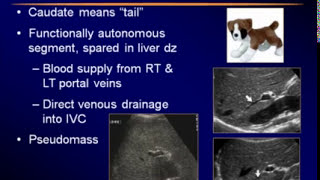 Sonography of the Liver [upl. by Zahc]