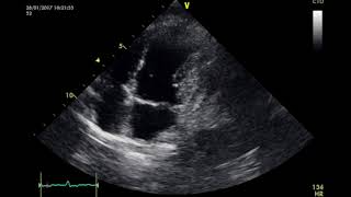 Erhlichiosis y Taponamiento Cardiaco [upl. by Bakemeier115]