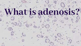 What is Adenosis  Pathology mini tutorial [upl. by Rehpotsirhcnhoj438]