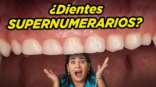 Dientes supernumerarios ¿Qué son y cómo se trata [upl. by Buckley]