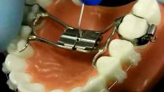 Bracesquestionscom  Orthodontic Jaw Expander How to Turn [upl. by Harlamert56]