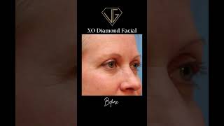 XO Diamond Facial Radiant Skin Transformation [upl. by Otipaga518]