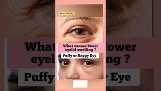 What Causes Puffiness Under Eye [upl. by Pul]