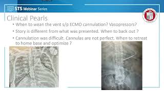 Dos and Donts of the Mobile ECMO Team March 3 2022 [upl. by Forras980]