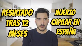 INJERTO CAPILAR EN ESPAÑA  RESULTADOS TRAS 12 MESES [upl. by Htrowslle]