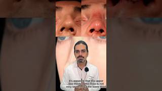 How to get fast recovery after septorhinoplasty  celebrity surgery beauty [upl. by Halimaj]