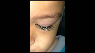 Toddler Pink Eye Conjunctivitis [upl. by Seni]