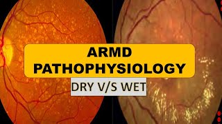 Age related macular degeneration AMD  Pathogenesis of dry AMD and Wet AMD drusens CNVM [upl. by Niatsirk]