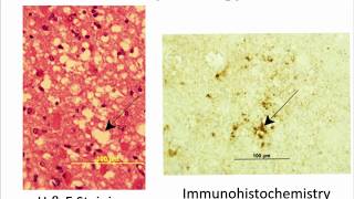 Prion DiseaseCJD CreutzfeldJakob Disease Basics  Brian Appleby [upl. by Ragen]