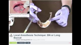 Long Buccal Dental Anesthesia Technique [upl. by Marwin191]