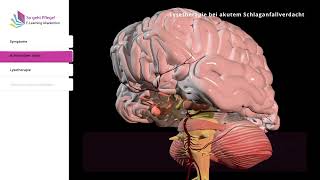 Lysetherapie bei akutem Schlaganfallverdacht [upl. by Eceinart]