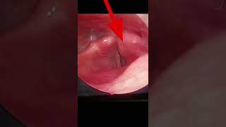 Normal Larynx vs Larynx Cancer  Fixed vocal cord Hoarse voice  आवाज़ ख़राब होना shorts viral [upl. by Oren]