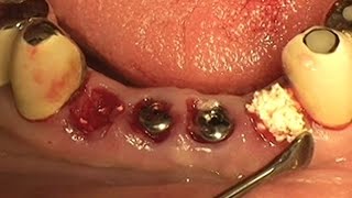 Socket preservation using alloplastic graft material OSTEON™ [upl. by Neelram]