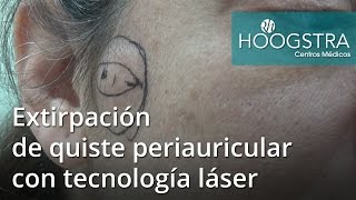 Extirpación de quiste periauricular con tecnología láser 16125 [upl. by Yrojram]