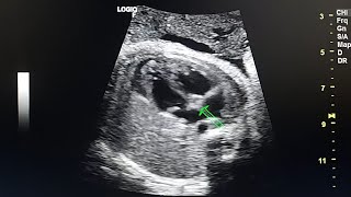 Right pulmonary aplasia in prenatal ultrasound [upl. by Otrebide386]