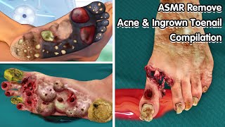 ASMR Remove Acne amp Ingrown Toenail Compilation  Deep Cleaning Animation [upl. by Aliza]