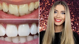 What is Enlighten Teeth Whitening [upl. by Llerryt]