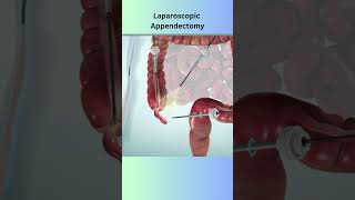 Appendectomy medical animation medicaleducation anatomy surgerysimulator [upl. by Sivatnod]