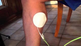 Complete Achilles Tendon Rupture Electronic Muscle Stimulation Rehab [upl. by Ellwood926]