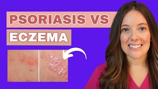 Do you Have Psoriasis or Eczema [upl. by Duax]