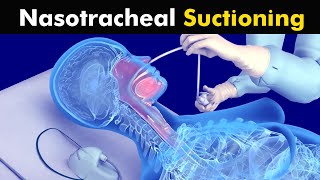 How Nasotracheal suction is performed [upl. by Cyrill]