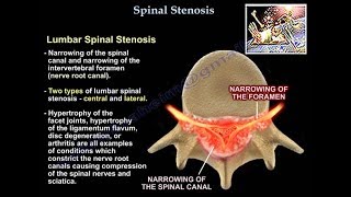 Lumbar Spinal Stenosis  Everything You Need To Know  Dr Nabil Ebraheim [upl. by Fleisher]