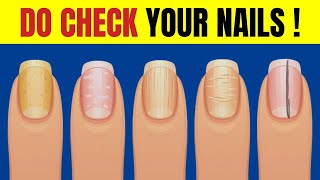 What Your Nails Say About Your Health [upl. by Hgielyk]