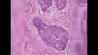 Histopathology Cervix Squamous cell carcinoma [upl. by Eudocia]