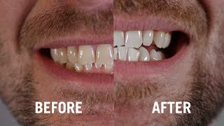 Dr Georges Dental White for 5 Days Before and After [upl. by Corette252]