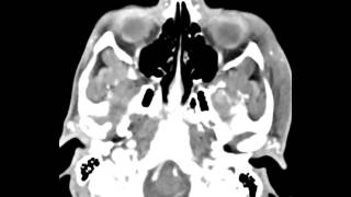 Mandibular Condyle Osteochondroma [upl. by Dyal]