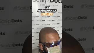 Scalp micropigmentation finish look scalpmicropigmentationindia hair scalpmicropigmentation [upl. by Eden318]