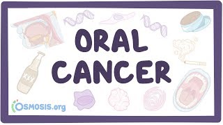 Oral Cancer  causes symptoms diagnosis treatment pathology [upl. by Celeste667]