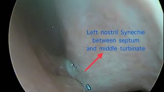 Synechiae release under local anesthesia [upl. by Munn]