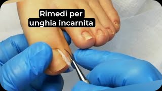 Rimedi per unghia incarnita Come applicare il cotone sotto lunghia incarnita [upl. by Samara]