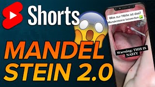 Mandelstein selber entfernen shorts [upl. by Narhet]