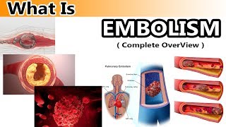 What is Embolism  Clear amp Complete Overview [upl. by Studley]