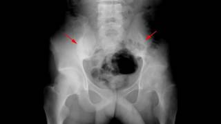 Ankylosisng spondylitis [upl. by Aivilys]