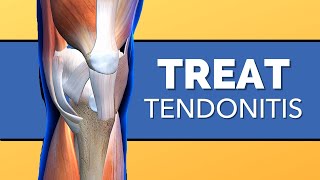 How to Treat Tendonitis of the Knee [upl. by Solhcin]