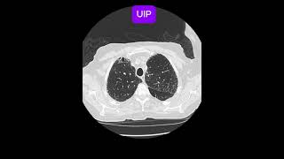 Usual interstitial pneumonia UIP [upl. by Adlev]