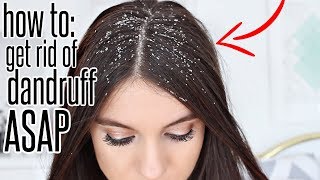 How To Get Rid Of Dandruff After ONE WASH [upl. by Eiuqram754]