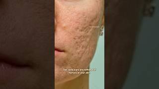 How to get rid of acne scars with Tretinoin  Acne scar Treatment sristydutta acnescars shorts [upl. by Clemen]