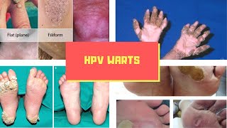 HPV Warts Symptoms – Causes Symptoms and Pictures of HPV Virus Warts in Men women [upl. by Tamah]